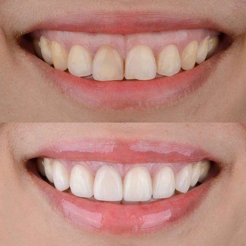 Benefits-of-Laser-Gum-Reshaping-dubai-uae.jpg