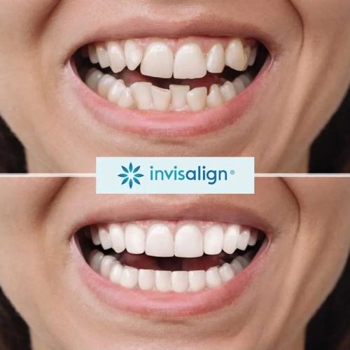 invisalign-before-and-after-photos.jpg